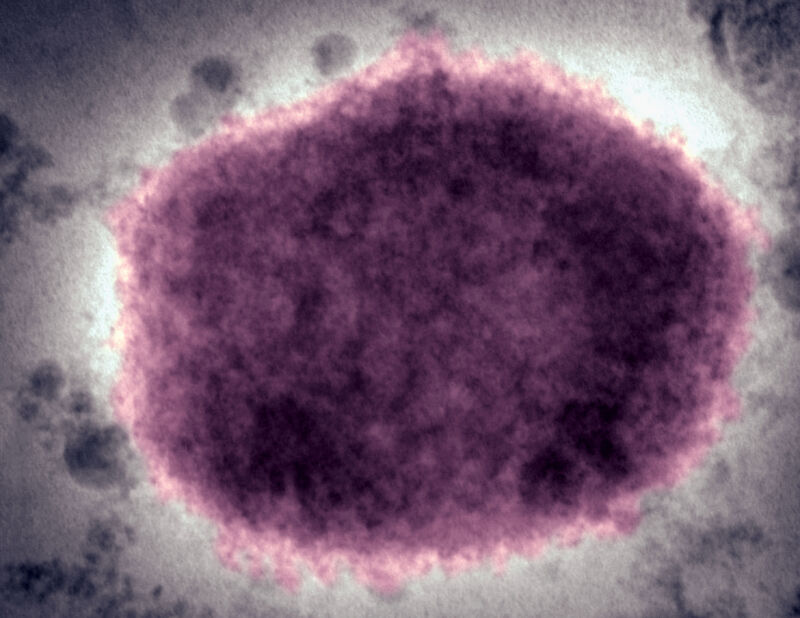 Una micrografía electrónica negativa de un virión del virus de la viruela símica en líquido vesicular humano. 